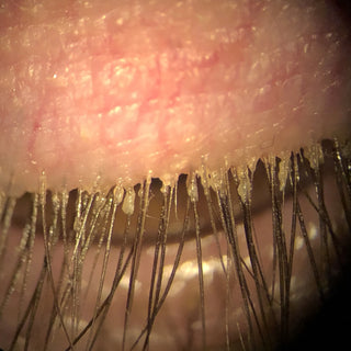 Eyelash Mites / Demodex Blepharitis: Causes, Symptoms, and Treatments