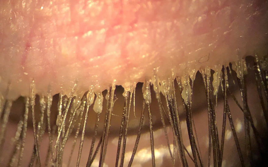 Eyelash Mites / Demodex Blepharitis: Causes, Symptoms, and Treatments